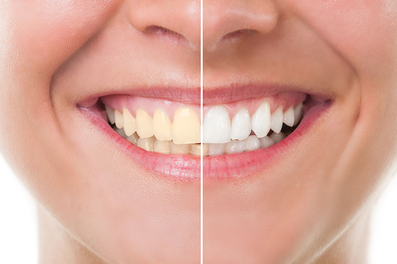 Teeth Whitening - Avondale Family Dental Care, PC, Avondale Dentist